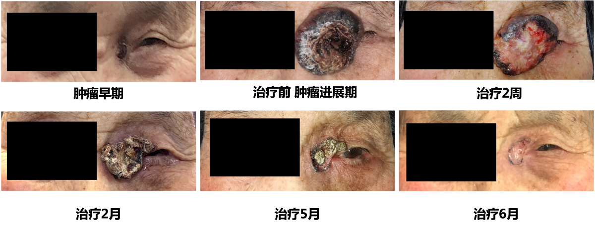 一例无法耐受手术的基底细胞癌，靶向治疗前后对比