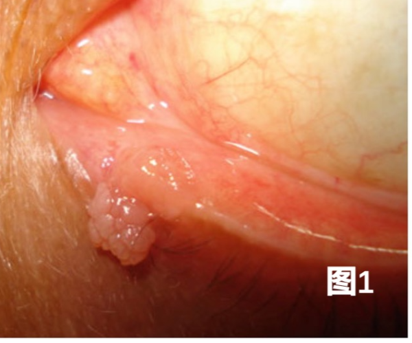 鳞状细胞乳头状癌，一类最常见的眼睑良性肿瘤