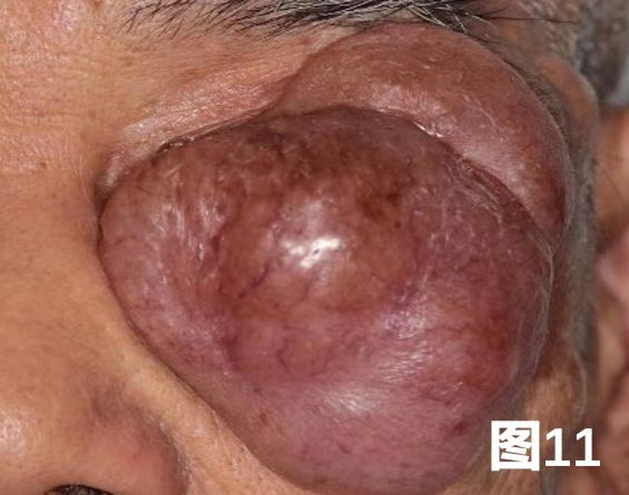 进展期粘液腺癌